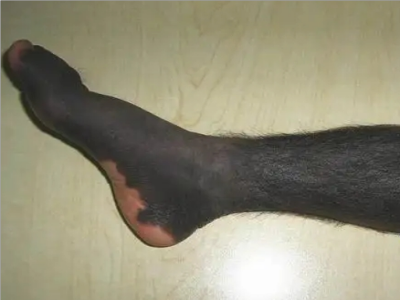 獸皮痣小腿皮膚發黑毛髮過長圖