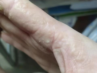 手部濕疹右手食指外側邊緣有脫皮圖