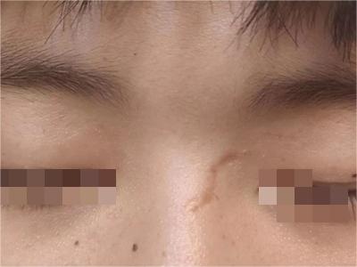 萎縮性瘢痕鼻部有線狀凹陷瘢痕圖 萎縮性瘢痕鼻部有線狀凹陷瘢痕圖
