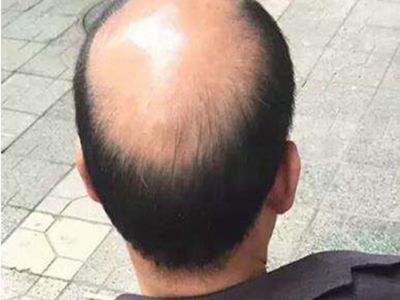 男性型脫髮頭頂禿了頭皮很油圖