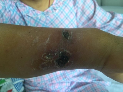 糖尿病性皮膚病胳膊傷口結痂發黑圖 糖尿病性皮膚病胳膊傷口結痂發黑圖