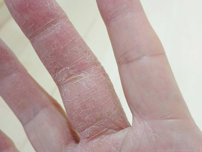 手部濕疹手指乾燥有白色紋路圖