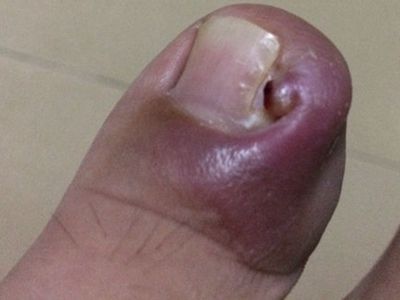 嵌甲大腳趾紅腫嚴重甲緣長個小腫塊圖 嵌甲大腳趾紅腫嚴重甲緣長個小腫塊圖
