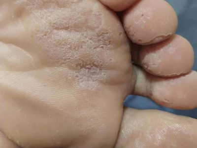 窩狀角質松解症腳底很多小坑圖