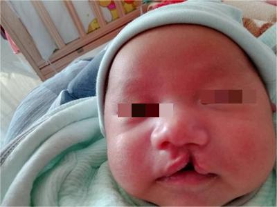 先天性外胚葉發育不良嘴唇合不上圖 先天性外胚葉發育不良嘴唇合不上圖