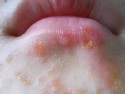 新生兒膿皰瘡嘴巴旁邊長皰結痂圖 新生兒膿皰瘡嘴巴旁邊長皰結痂圖