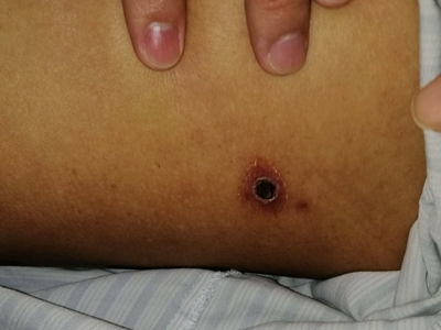恙蟲病大腿上有黑色焦痂圖 恙蟲病大腿上有黑色焦痂圖