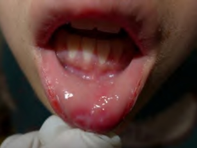頜面部獲得性梅毒嘴唇內側有白斑圖 頜面部獲得性梅毒嘴唇內側有白斑圖