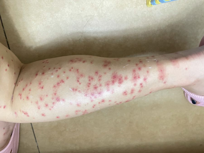 蠓蟲叮咬小腿上有一堆丘疹圖