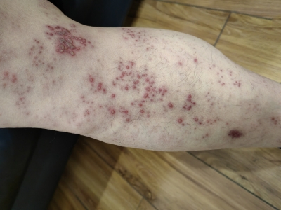 愛滋病感染性皮膚損害小腿水皰圖 愛滋病感染性皮膚損害小腿水皰圖