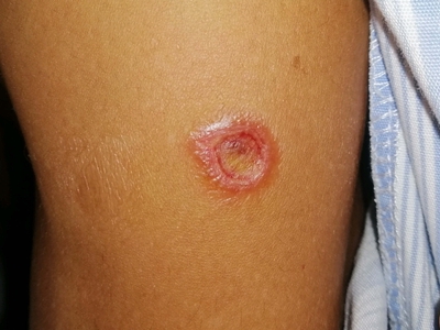 恙蟲病大腿上有淡紅色創面圖