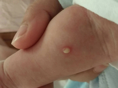 新生兒膿皰瘡手臂出現一個黃色膿包圖 新生兒膿皰瘡手臂出現一個黃色膿包圖