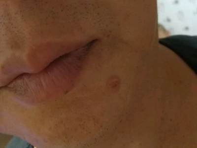 孤立性毛髮上皮瘤下巴上長一圓疙瘩圖 孤立性毛髮上皮瘤下巴上長一圓疙瘩圖