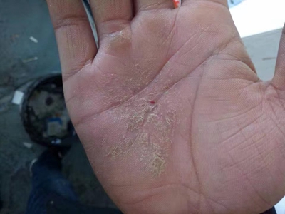 手部濕疹右手掌中間增厚變黃圖 手部濕疹右手掌中間增厚變黃圖