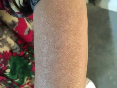 特發性滴狀色素減少症胳膊起白斑圖 特發性滴狀色素減少症胳膊起白斑圖