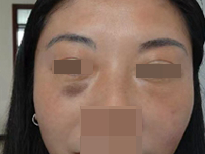 咖啡斑眼下有一塊棕褐色斑塊圖 咖啡斑眼下有一塊棕褐色斑塊圖
