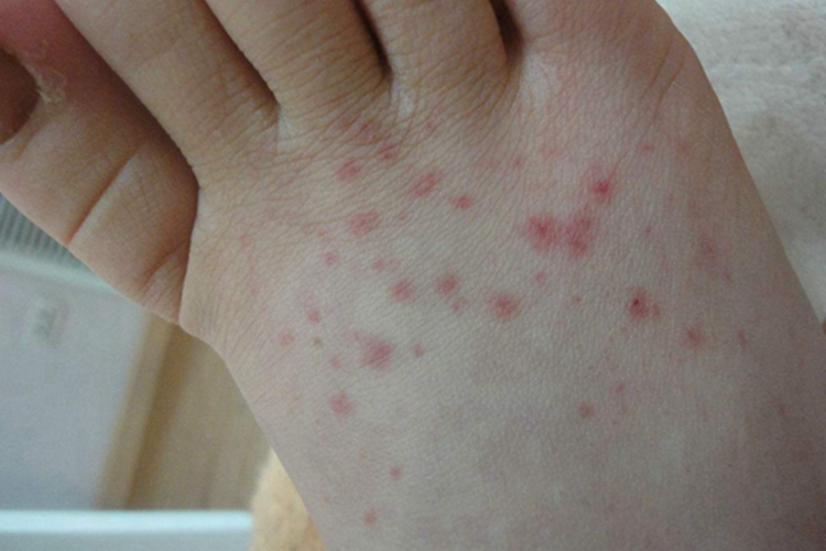 小兒過敏性紫癜腳背上有紅點圖