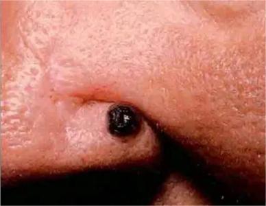 結節型黑色素瘤鼻翼上長黑色結節圖 結節型黑色素瘤鼻翼上長黑色結節圖