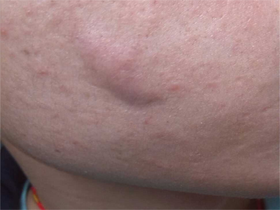 寒冷性脂膜炎臉頰起了一個硬塊圖
