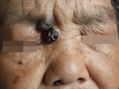 結節型黑色素瘤眼角有黑色結節圖 結節型黑色素瘤眼角有黑色結節圖