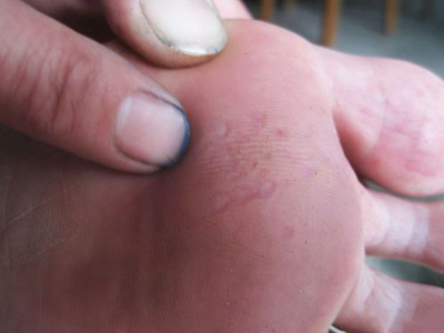 溝狀跖部角質松解症腳底有些小坑圖 溝狀跖部角質松解症腳底有些小坑圖