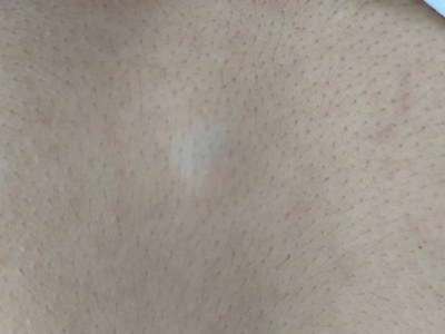 皮脂腺囊腫後背上有個疙瘩圖 皮脂腺囊腫後背上有個疙瘩圖