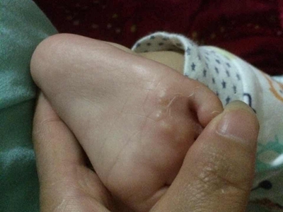 嬰兒肢端膿皰病腳底長密集的水皰圖 嬰兒肢端膿皰病腳底長密集的水皰圖