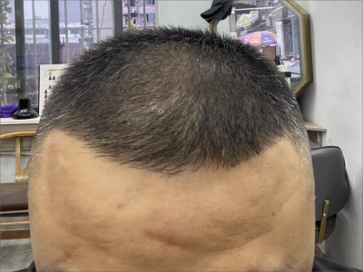 雄激素性脫髮髮際線後退額頭寬大圖 雄激素性脫髮髮際線後退額頭寬大圖