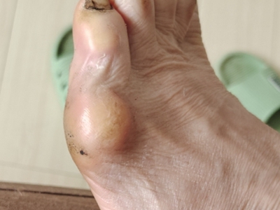 皮膚纖維瘤腳上長一個半球形結節圖 皮膚纖維瘤腳上長一個半球形結節圖