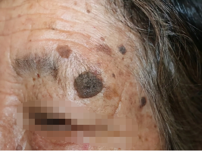 光線性角化病眉毛上長一個大黑斑圖 光線性角化病眉毛上長一個大黑斑圖