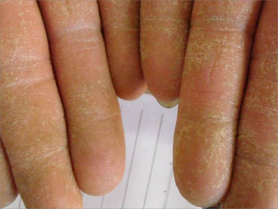 手部濕疹手指有脫落的黃色痂皮圖 手部濕疹手指有脫落的黃色痂皮圖