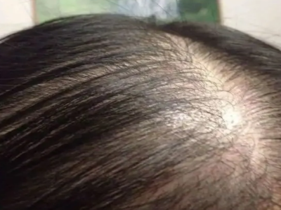 女性型脫髮頭頂發縫大露頭皮圖 女性型脫髮頭頂發縫大露頭皮圖