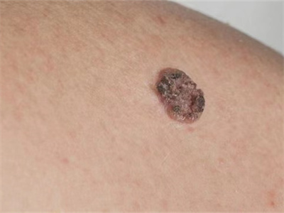 淺表播散型黑色素瘤大腿長黑斑圖 淺表播散型黑色素瘤大腿長黑斑圖