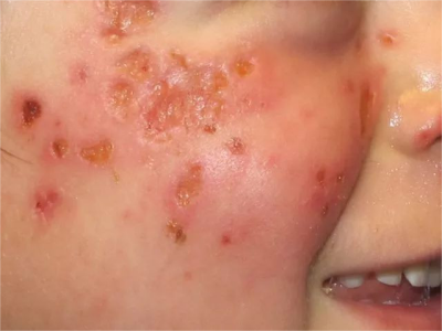 種痘樣水皰病臉上一塊塊結痂圖