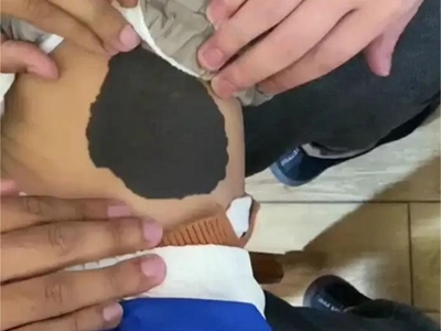 獸皮痣腹部有不規則像圓形的黑斑圖