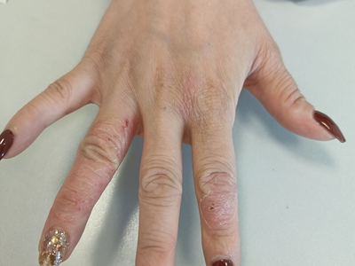 手部濕疹右手示指和無名指有脫皮圖 手部濕疹右手示指和無名指有脫皮圖