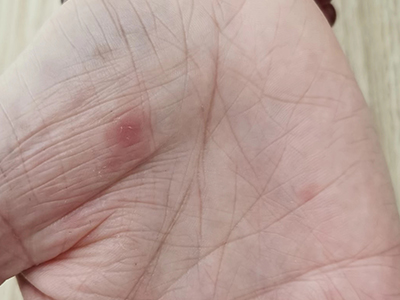 斑疹性梅毒疹手掌有紅斑圖 斑疹性梅毒疹手掌有紅斑圖