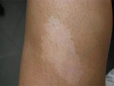 脫色素性痣大腿上有白色斑塊圖