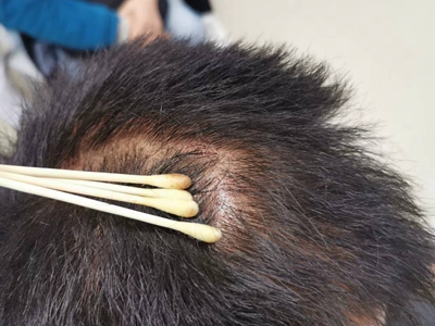 男性型脫髮頭皮有出血點頭髮脫落圖 男性型脫髮頭皮有出血點頭髮脫落圖