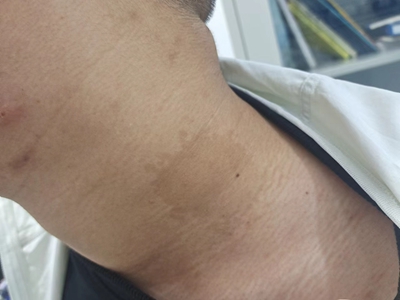 咖啡斑頸部有一塊不規則斑塊圖