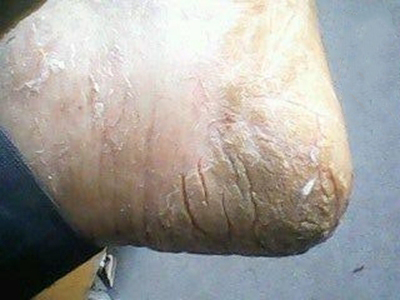 手足皸裂腳後跟乾燥多處裂口圖