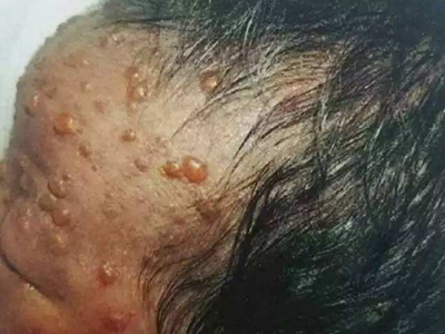 新生兒膿皰瘡前額許多散在水皰圖 新生兒膿皰瘡前額許多散在水皰圖