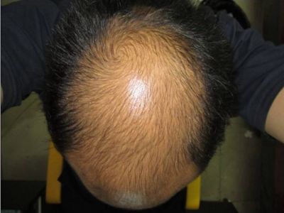男性型脫髮頭頂處頭髮稀疏圖