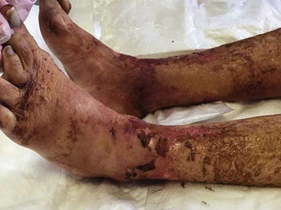 煙酸缺乏症小腿上有很多褐色結痂圖 煙酸缺乏症小腿上有很多褐色結痂圖