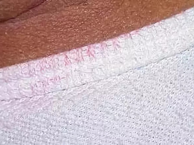 色汗症腋窩出汗將衣服染紅圖 色汗症腋窩出汗將衣服染紅圖
