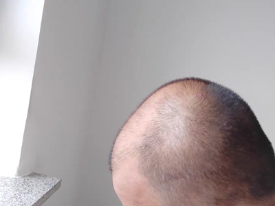 雄激素性脫髮頭頂禿得快成地中海圖 雄激素性脫髮頭頂禿得快成地中海圖