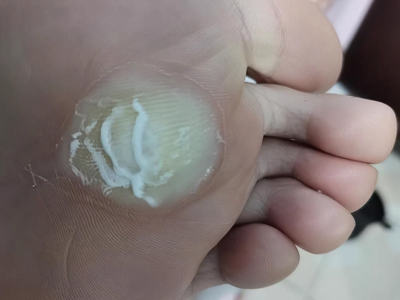 胼胝腳底有大塊黃色脫皮的硬塊圖 胼胝腳底有大塊黃色脫皮的硬塊圖