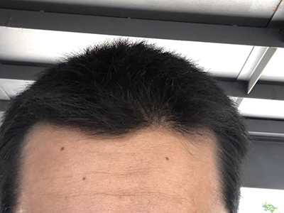 雄激素性脫髮前額髮際線明顯後移圖