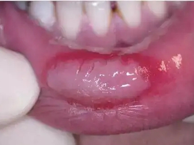 三期口腔梅毒下嘴唇內側潰瘍發白圖 三期口腔梅毒下嘴唇內側潰瘍發白圖