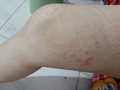 色素性痒疹大腿內側出現散在小紅點圖